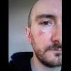 Saturday, Sep 20 2014,
Power of Scotland training again in prep for taking on team Ireland in a couple of weeks. Took a full force headbutt to the corner of my face/cheek/eye helmet first, now am bruised and have the start of a black eye